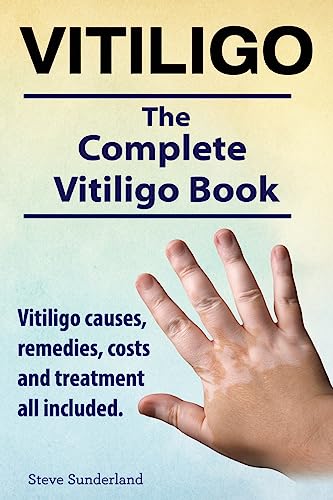 Vitiligo. Vitiligo causes, remedies, costs and treatment all included. The complete Vitiligo Book.